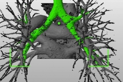 pulmonary_vascularity_bronchus_dicom_model_01