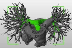 pulmonary_vascularity_bronchus_dicom_model_02