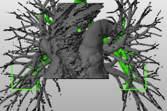 pulmonary_vascularity_bronchus_dicom_model_03