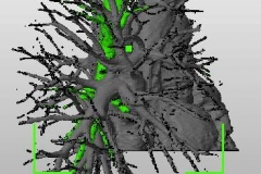 pulmonary_vascularity_bronchus_dicom_model_04